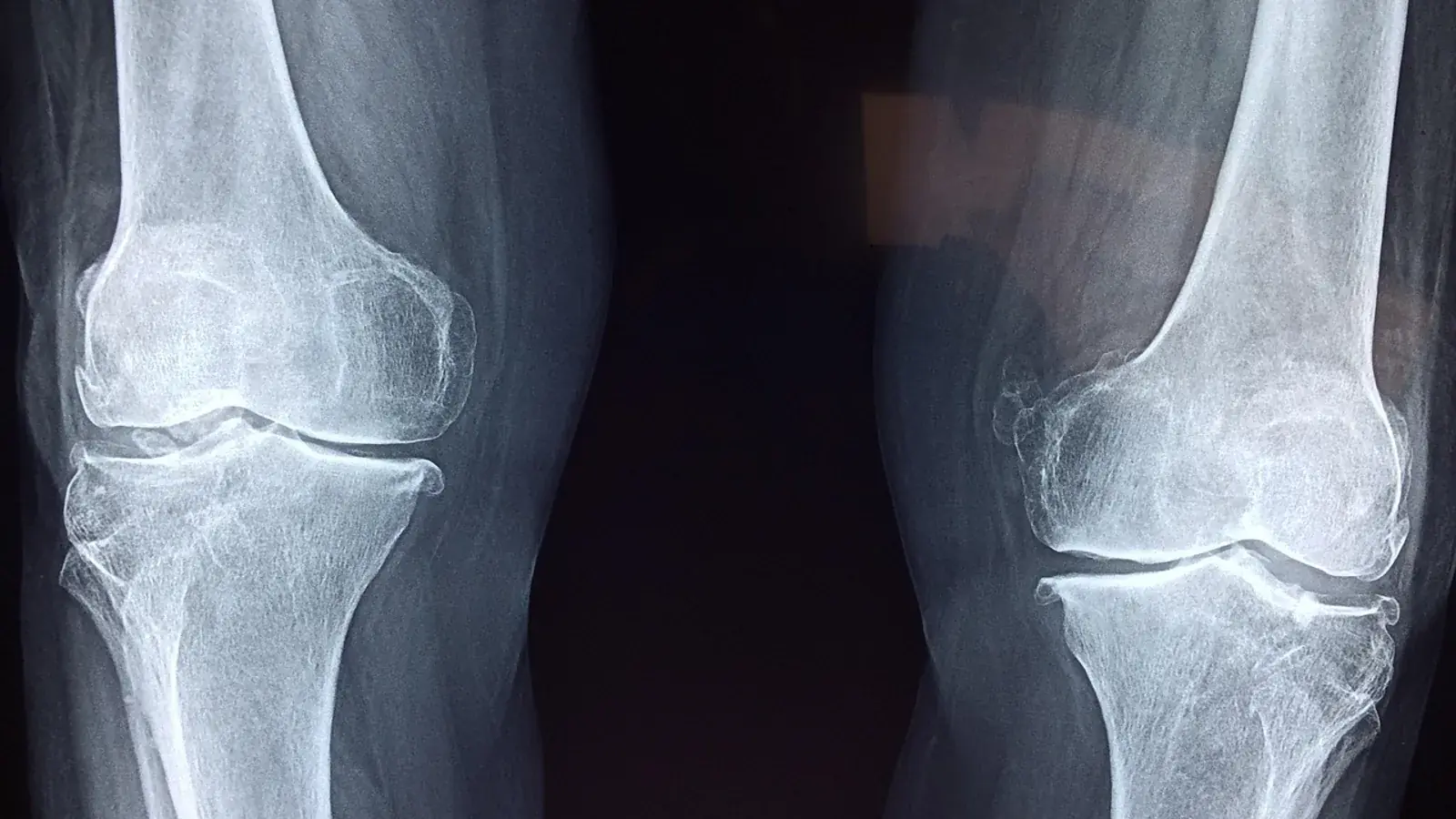 Röntgenaufnahme beider Kniegelenke mit Oberschenkelknochen und Schienbein